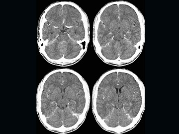2012年卫生高级职称考试放射医学专业中枢神